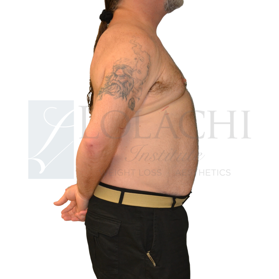 Before weight loss