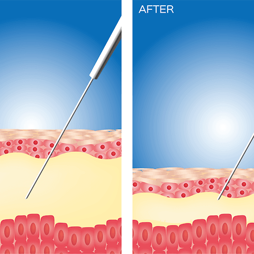 lipotropics lipotropics
